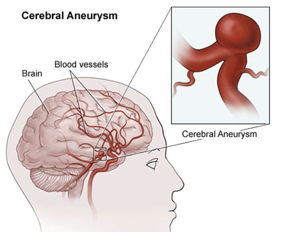 Аневризма в голове симптомы. Аневризма головного мозга.